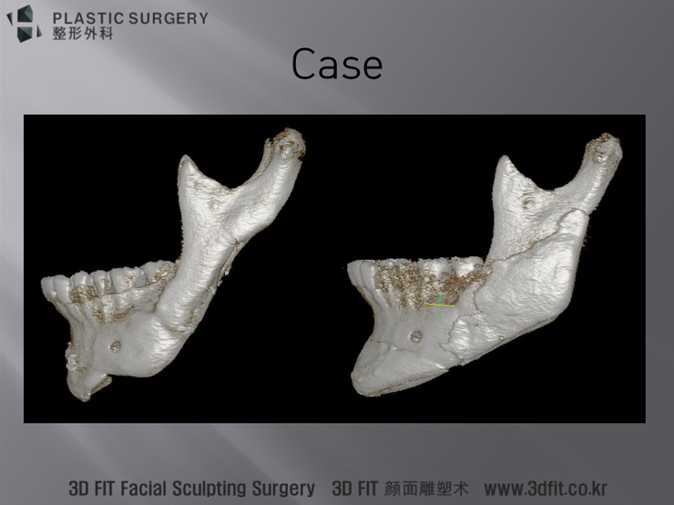 사각턱 재건 후 좌측 측면 3D CT
