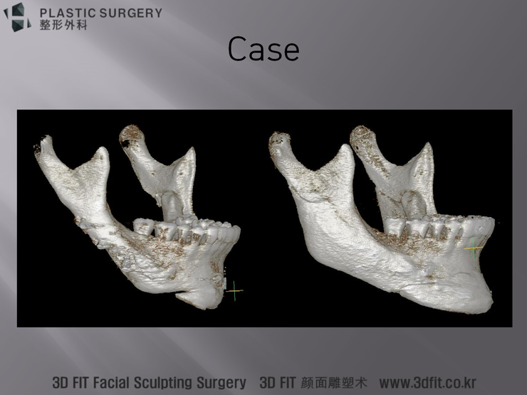 사각턱 재건 후 우측 사면 3D CT