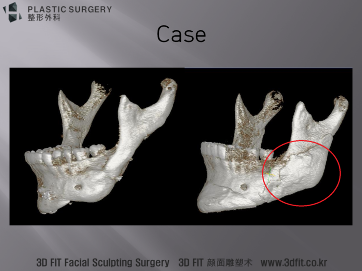 사각턱 재건 후 좌측 사면 3D CT