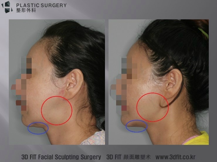 사각턱 재건 전후 좌측 측면 사진
