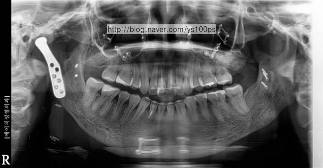 인공 턱관절과 다수 고정물이 보이는 파노라마 X-ray
