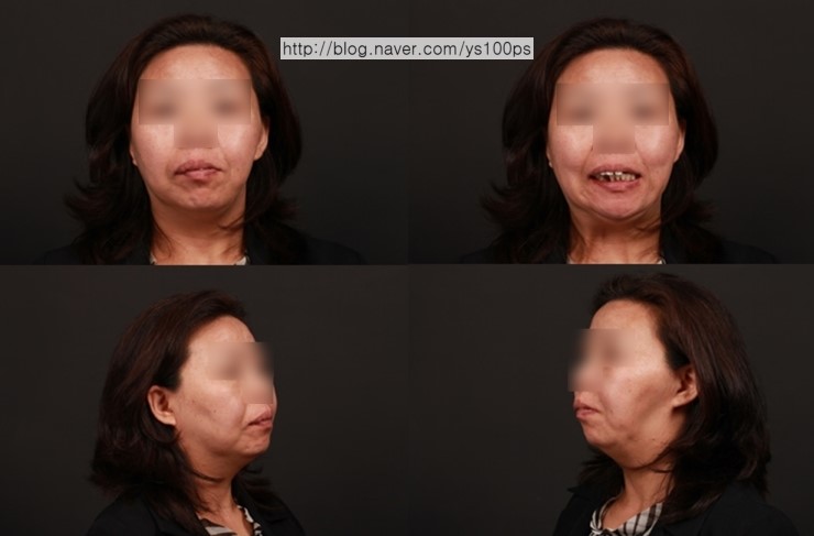 광범위 하악골 결손 환자의 정면 사진