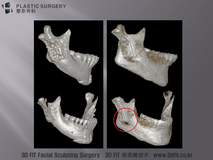 인공관절 주변을 비워 둔 하악 재건 3D CT