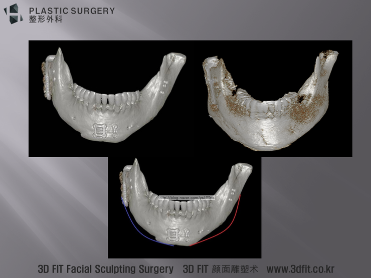 사각턱 재건 전후 정면 3D CT