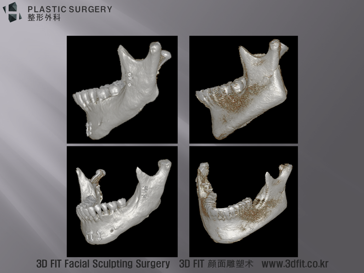사각턱 재건 후 좌측 3D CT