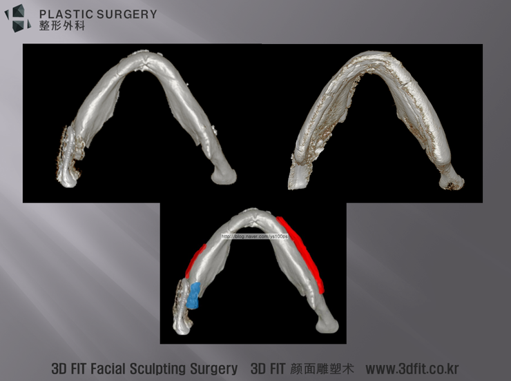 사각턱 재건 전후 아래쪽 3D CT