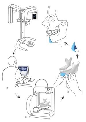 3D CT에서 맞춤 보형물까지의 제작 모식도