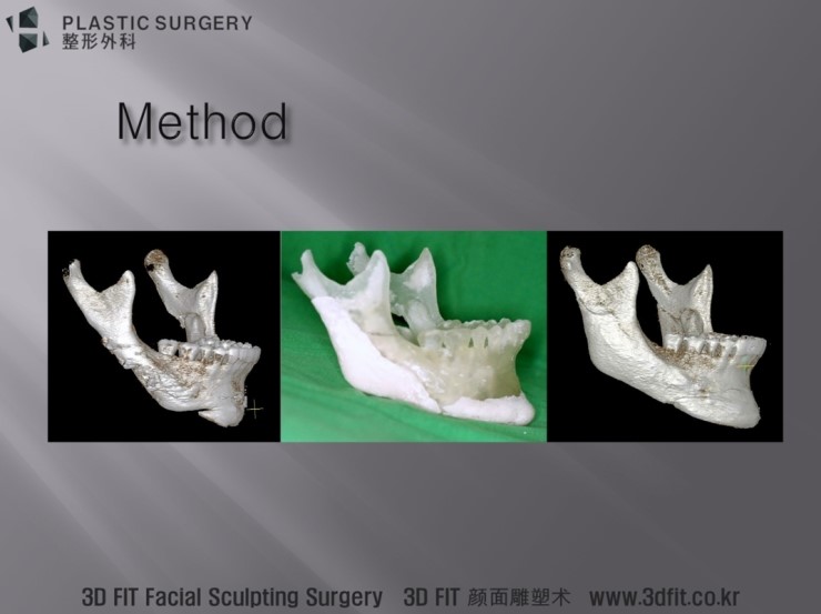 3D Fit 맞춤 보형물 제작 및 수술 과정