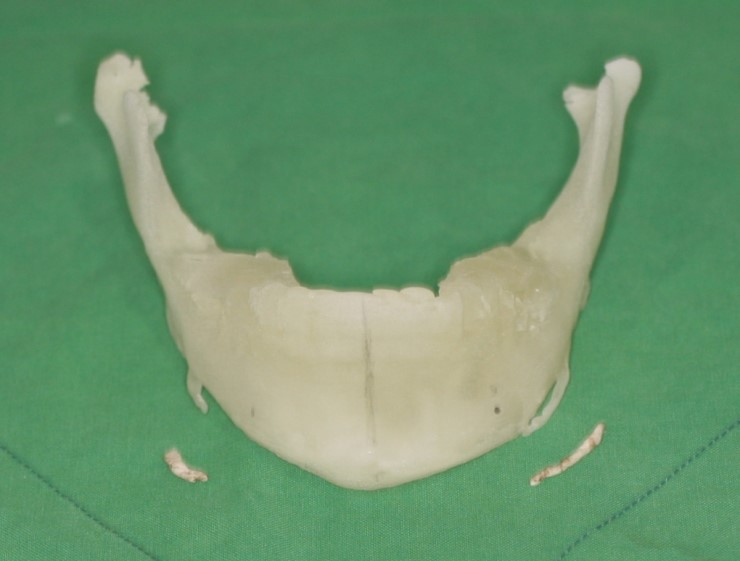 턱끝 돌출 골편을 재현한 3D 프린팅 하악골 모델