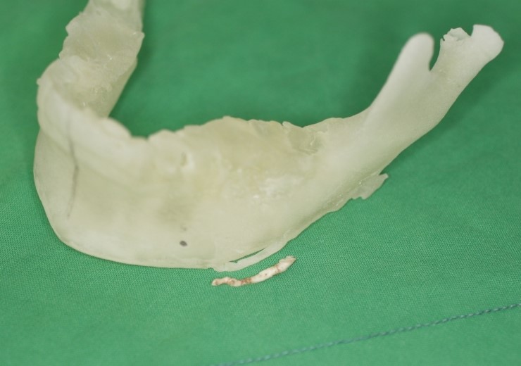 제거 골편과 3D 프린팅 모델 비교