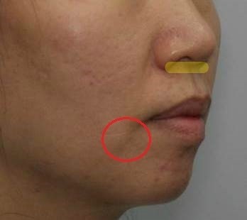 돌출입·무턱과 팔자주름이 동반된 다섯 번째 사례