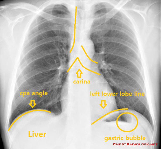 Xray 판독법 (carina, CPA angle, gastric bubble, Bowel perforation) 네이버 블로그