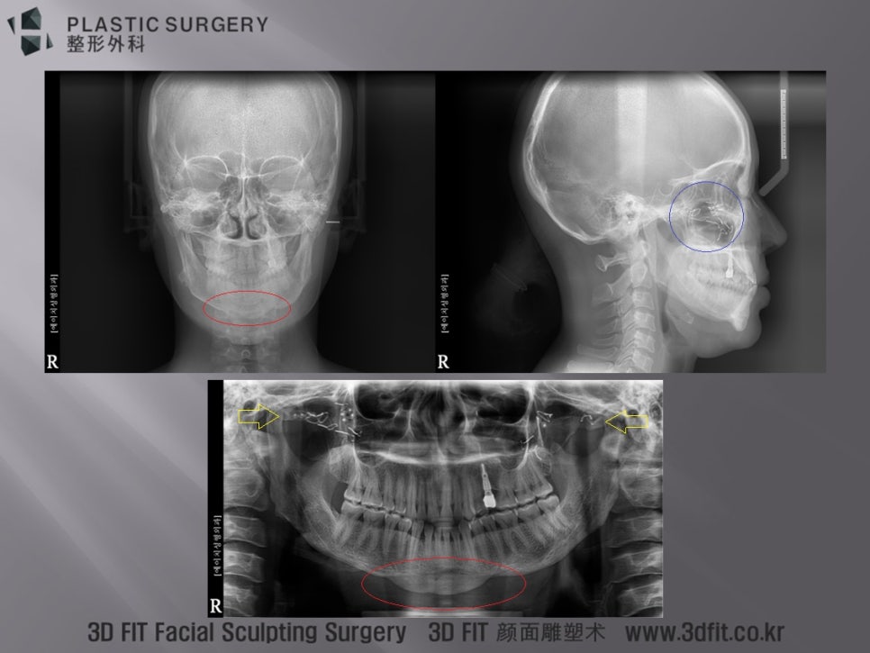 여러 차례 안면윤곽 수술의 흔적이 보이는 정면 X-ray