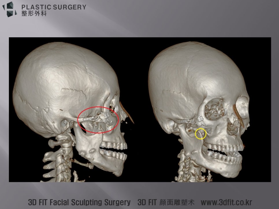 반복 수술과 뼈이식 후 골흡수가 남은 우측 광대 3D CT
