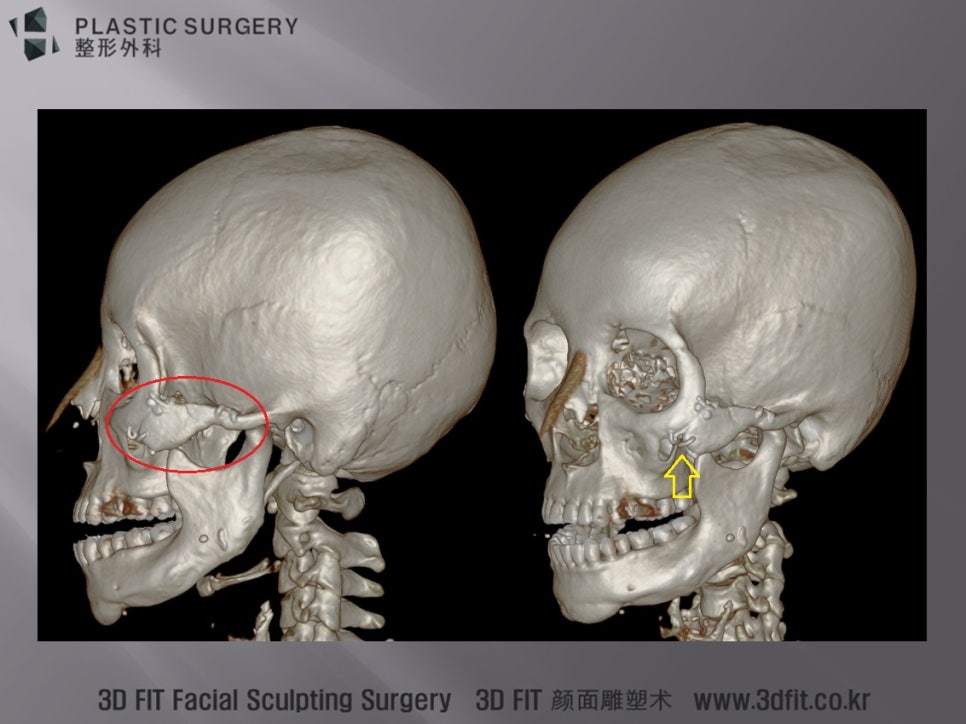 여러 플레이트와 와이어가 삽입된 좌측 광대 3D CT