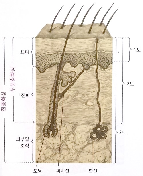 1도화상 2도화상 3도 화상의 종류와 증상과 치료 : 네이버 블로그