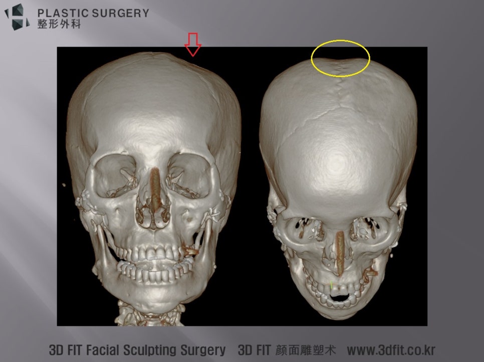광대 재건용 자가골 채취 후 생긴 두개골 함몰 3D CT