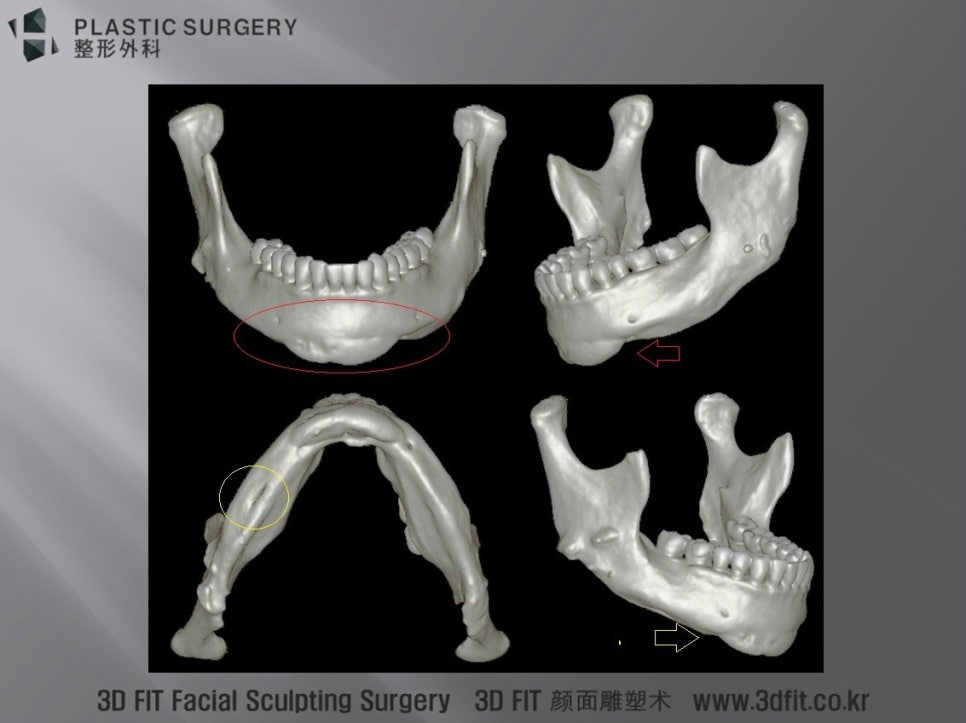 턱끝 계단현상과 하악 과절제 부위 3D CT