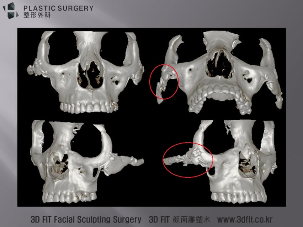 양측 광대 골격을 분리해 비교한 3D CT