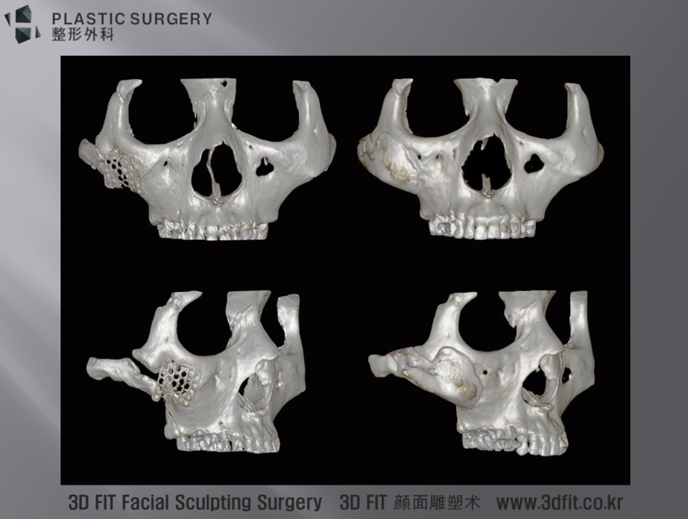 티타늄 맞춤 보형물 광대 재건 전후 정면·우측 3D CT