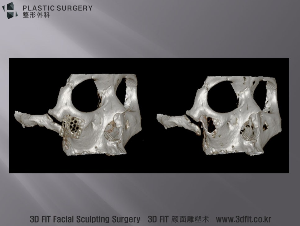 기존 메시 보형물을 소프트웨어로 제거한 광대 3D 데이터