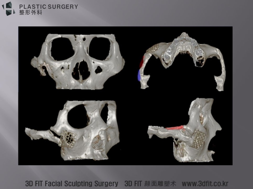 광대활 골변위와 좌우 비대칭을 표시한 수술 계획 3D CT