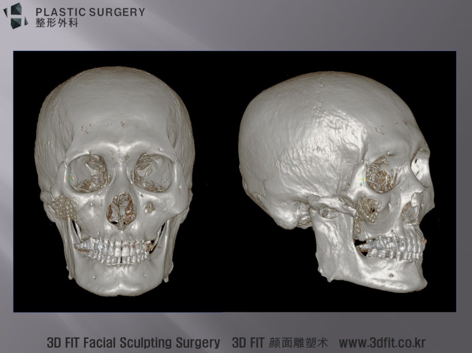 외상 후 광대 결손과 기존 메시 보형물이 보이는 수술 전 3D CT