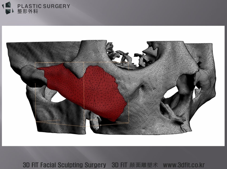 광대 결손 형태에 맞춘 티타늄 보형물의 첫 3D 모델링