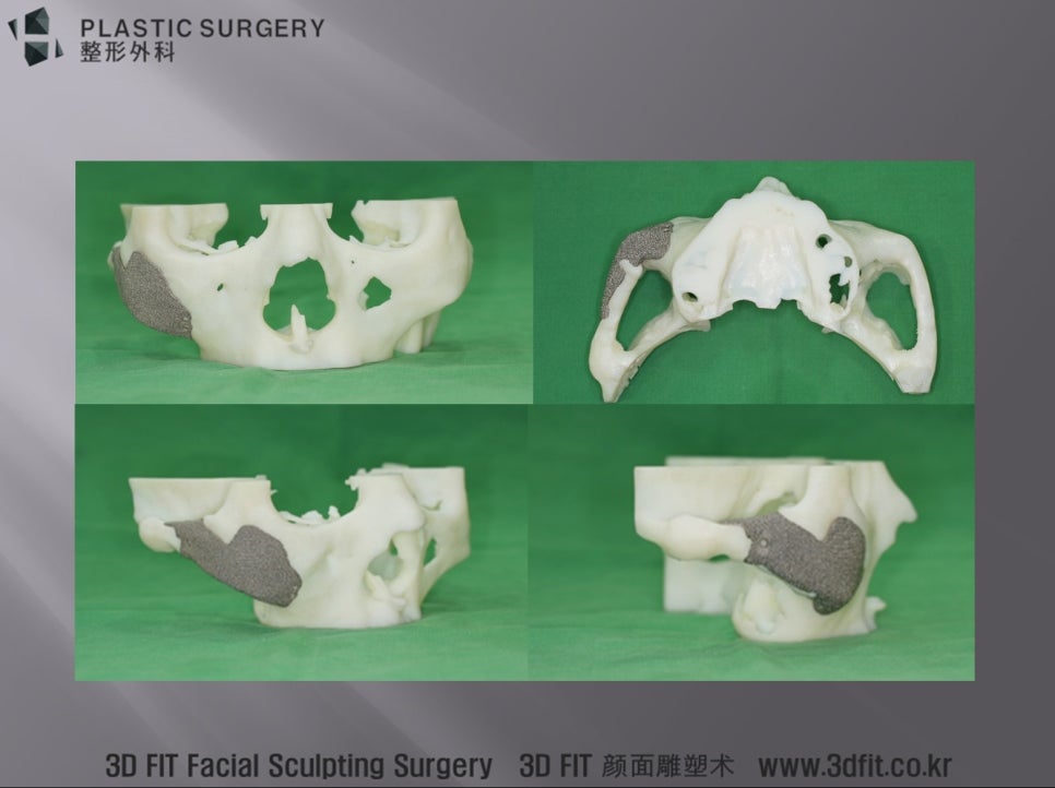 3D 프린터로 제작한 환자 맞춤형 티타늄 광대 보형물