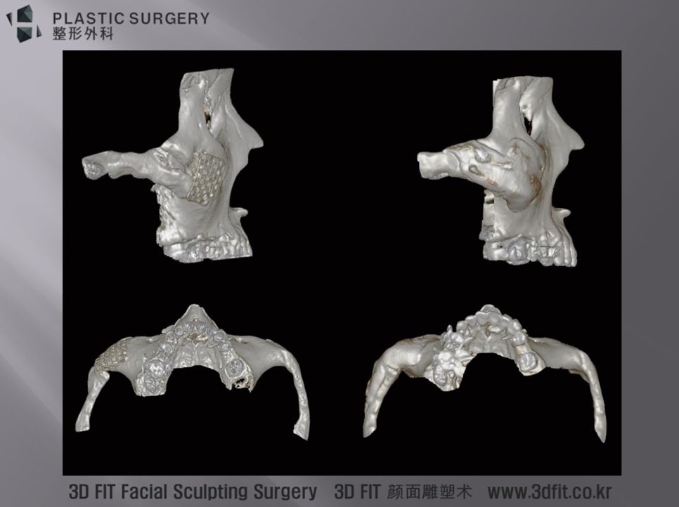 티타늄 광대 재건 후 광대활과 측면부를 확인한 3D CT