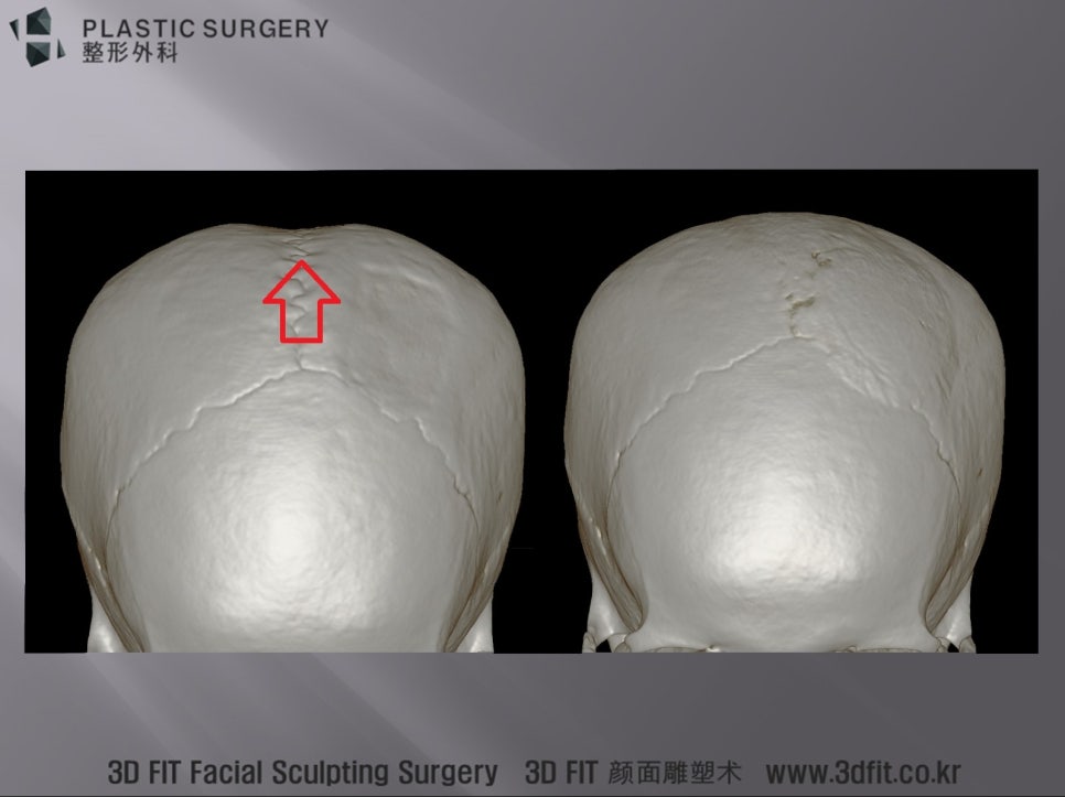 시상봉합선 함몰을 보완한 두상성형 전후 3D CT