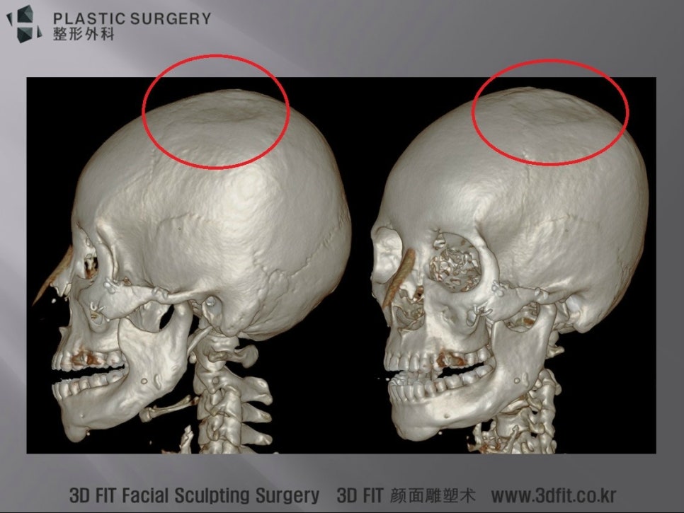 두개골 골편 채취 후 발생한 함몰 부위의 측면 3D CT