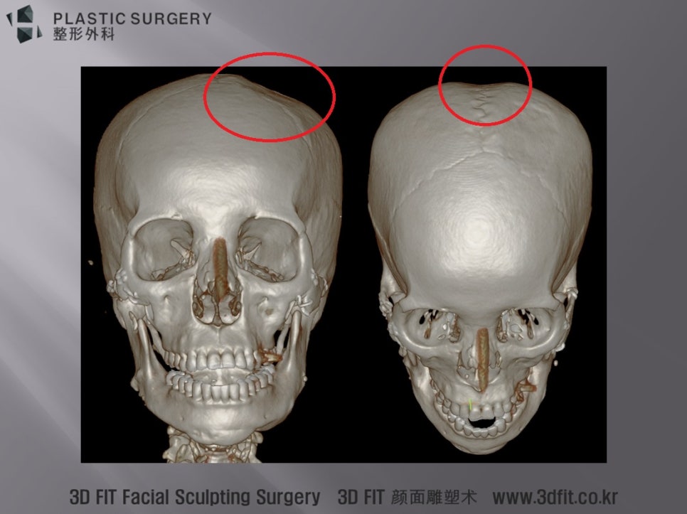 광대 재건용 골편 채취 부위와 시상봉합선 함몰이 보이는 3D CT