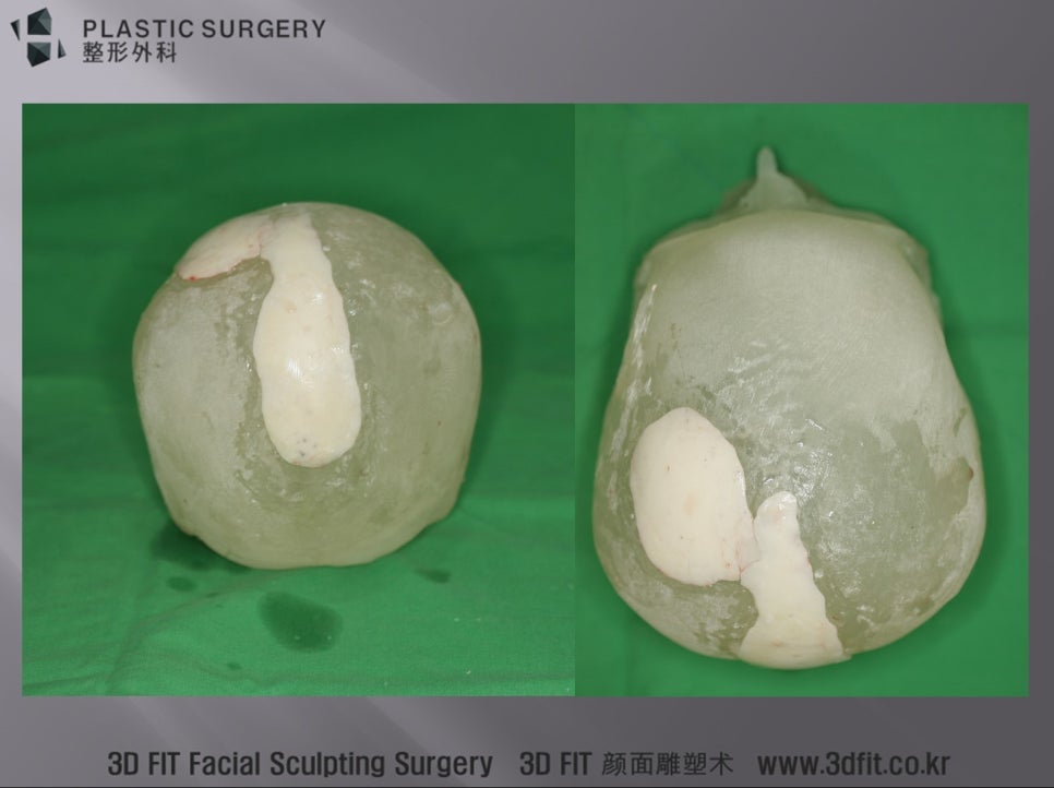 1대1 두개골 모형과 맞춤 제작한 3D Fit PMMA 보형물
