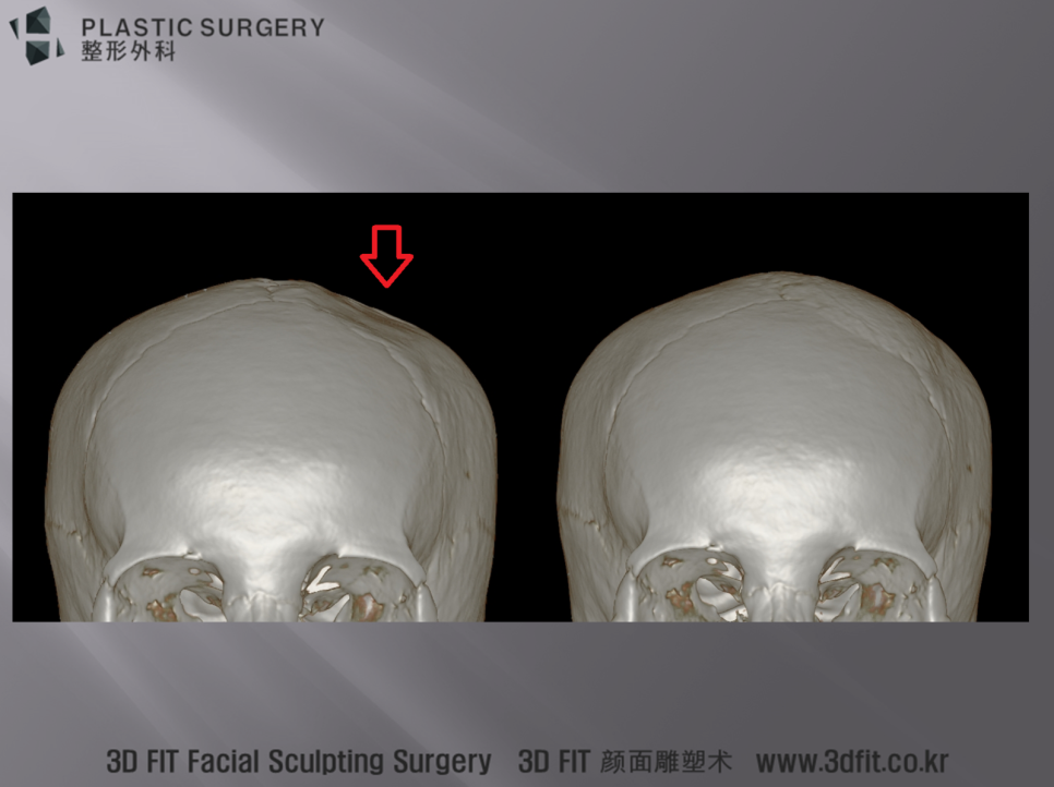 두개골 함몰 재건 수술 전후 정면 3D CT 비교