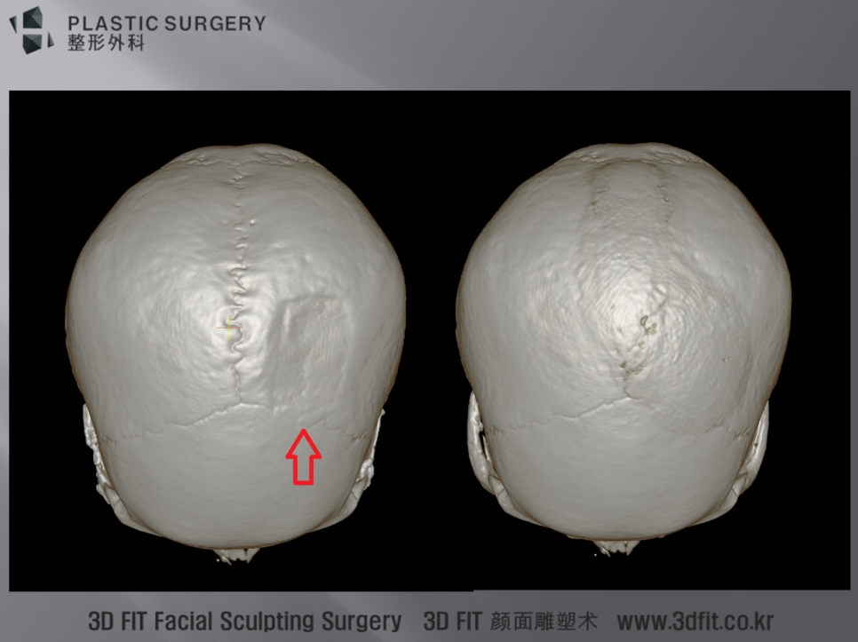 사각형 골편 채취 부위를 재건한 수술 전후 3D CT
