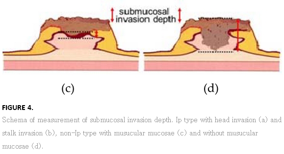 Submucosal invasive colorectal carcinoma [SICC] : 네이버 블로그