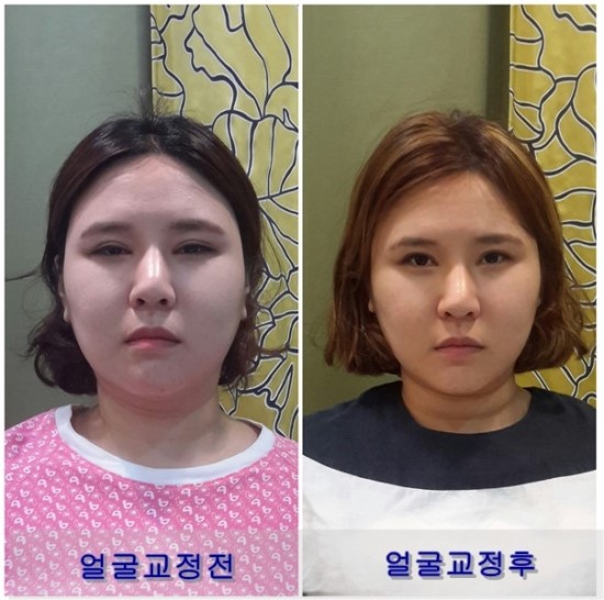 얼굴살빼는법-체형이 바르면 얼굴에 살들이 정리된다 : 네이버 블로그 얼굴살빼는법-체형이 바르면 얼굴에 살들이 정리된다 : 네이버 블로그