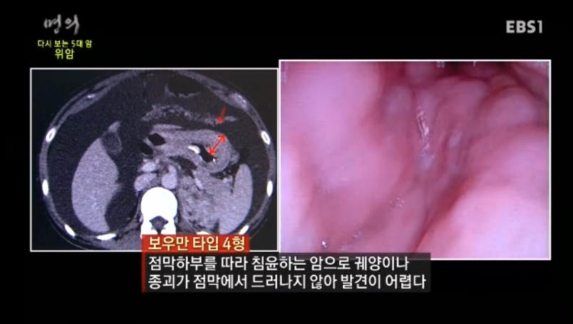 위암증상, 위암 초기증상과 위암 수술 : 네이버 블로그