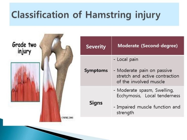 proximal-hamstring-tendinopathy-a-true-pain-in-the-butt