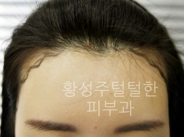 헤어라인 이미지