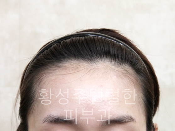 헤어라인 이미지