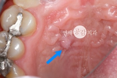 잇몸 고름주머니 신경치료 과정 : 네이버 블로그