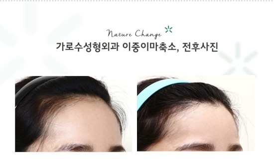 이마 이미지