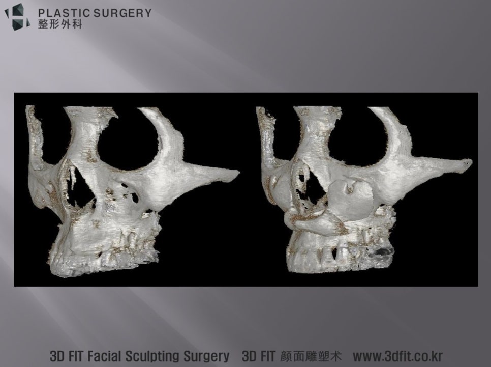 앞광대와 노블캣 보형물을 함께 삽입한 수술 전후 3D CT