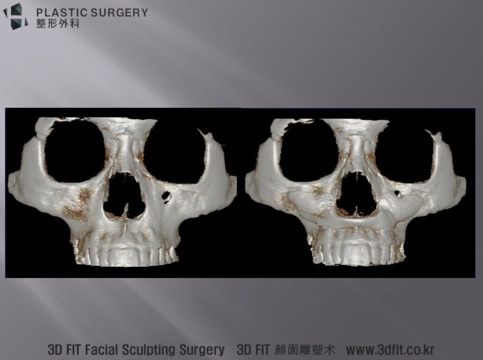 눈물고랑부터 앞광대까지 대칭적으로 삽입된 3D Fit 보형물