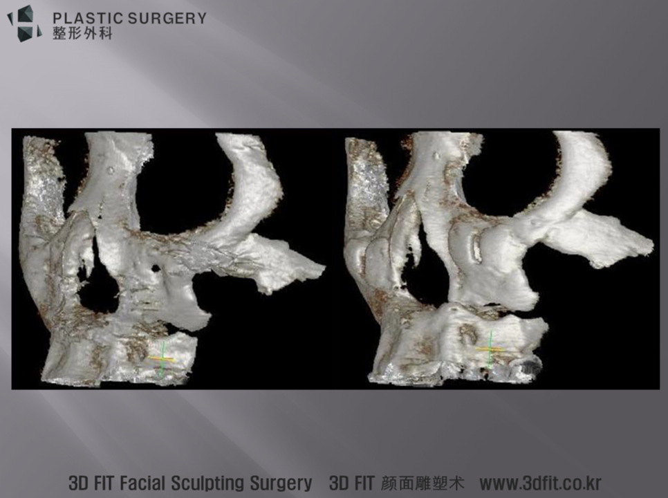 양악수술 고정물과 맞춤 앞광대 보형물이 보이는 수술 전후 3D CT