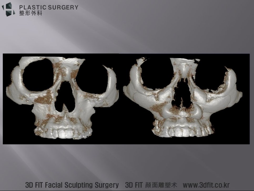 오목한 얼굴에 삽입한 앞광대와 노블캣 보형물 3D CT