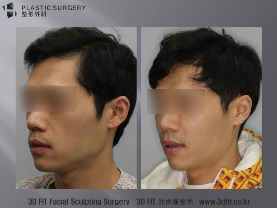 마른 남성의 눈물고랑과 앞광대 함몰 수술 사례