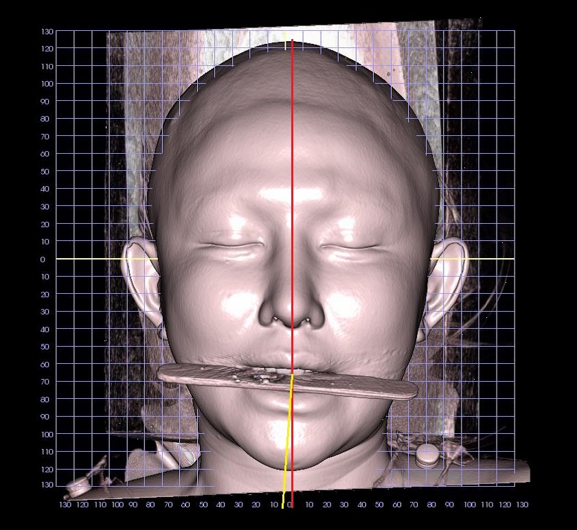 교합면 기울기와 얼굴 중심에서 벗어난 턱끝 피부 3D CT